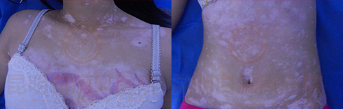 规范治疗白癜风 拒绝偏方外搽药